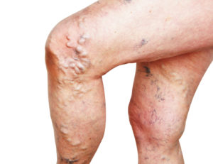 a woman suffering from varicose veins, which can be treated by Maryland Vascular Specialists